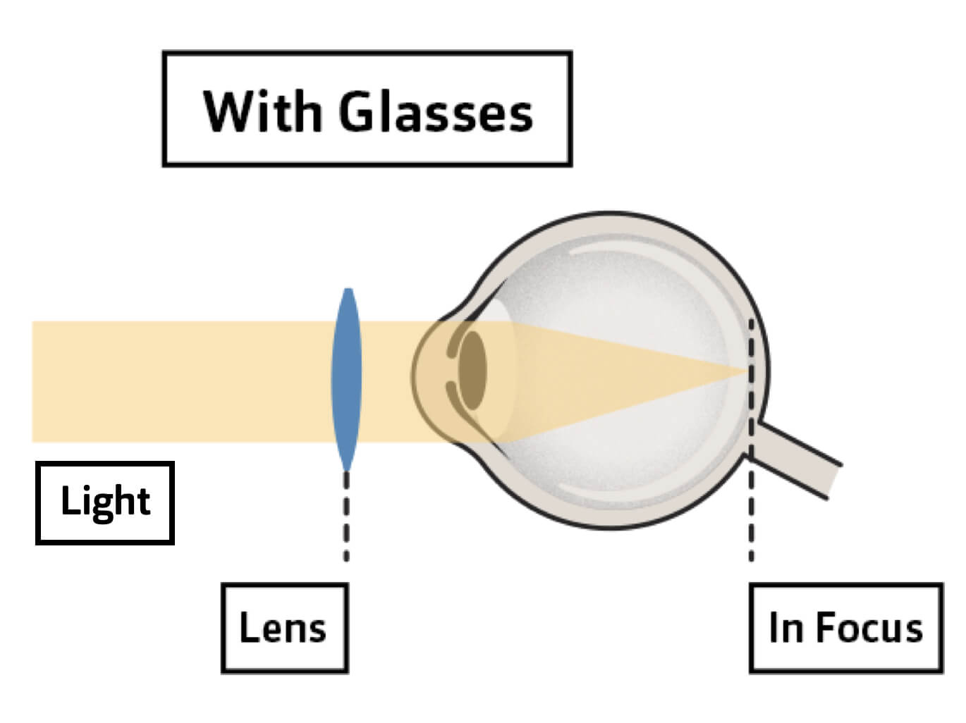 Is hypermetropia (farsightedness) a treatable condition? | Vision Express