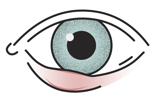 Terçolho | Sintomas & Causas | MultiOpticas